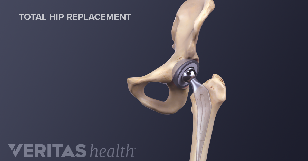 What Is The Cost Of A Hip Replacement thumbnail