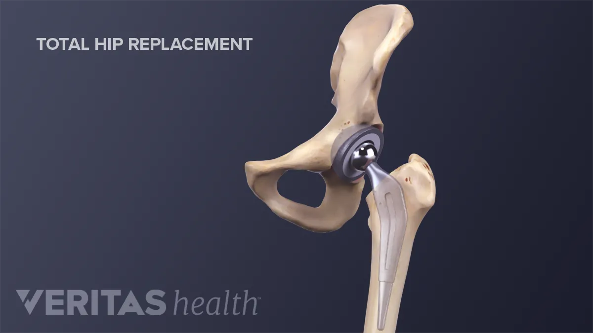 What Is Hip Osteoarthritis?