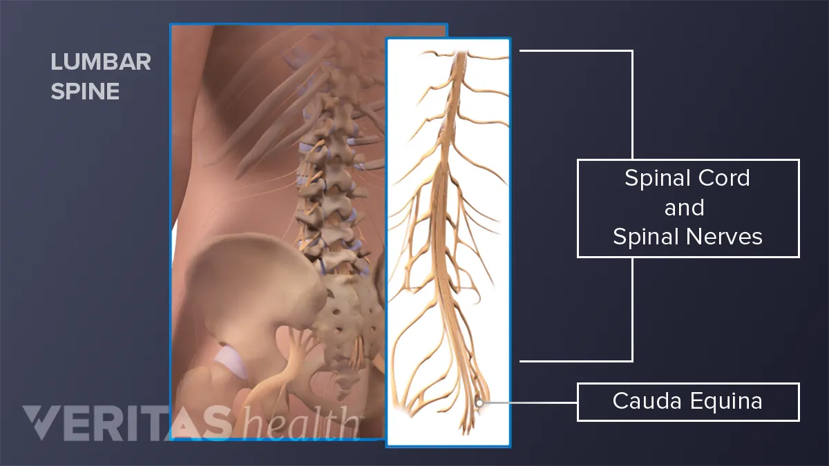 Piriformis Syndrome: Definition - Spine Info