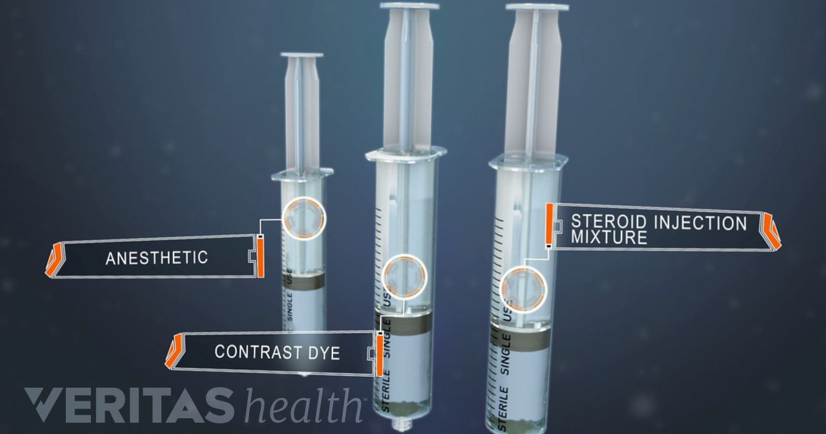 spinal steroid injection