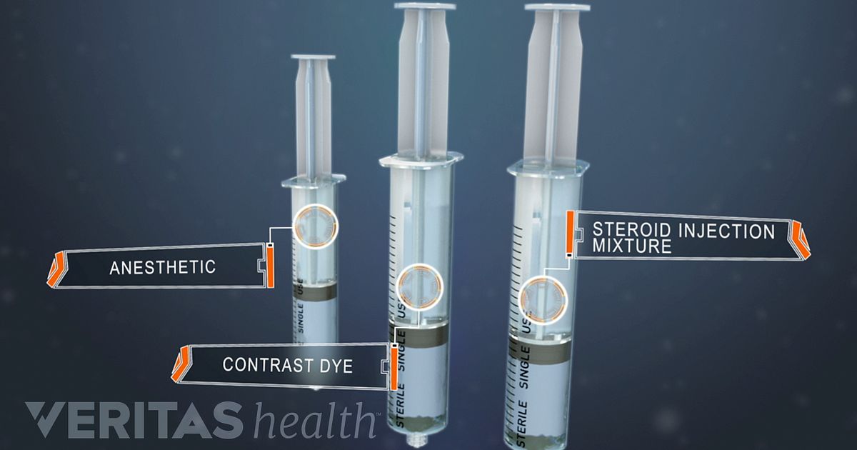 spinal steroid injection spinal steroid injection