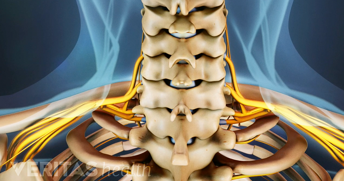 Artificial Disc for Cervical Disc Replacement