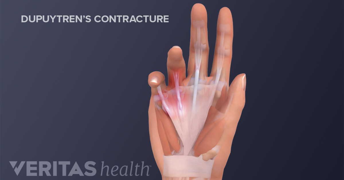 Dupuytren’s Contracture (Palmar Fibromatosis) Definition | Defined By ...