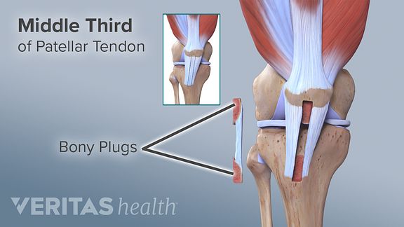 Acl Surgical Repair