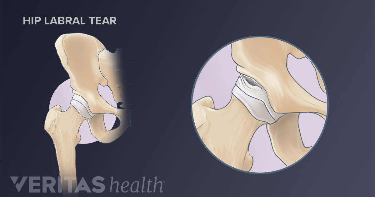 Hip Labral Tear Risk Factors and Causes