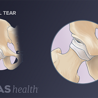 Anterior view of a intra articular hip labral tear zoomed out and more close up.