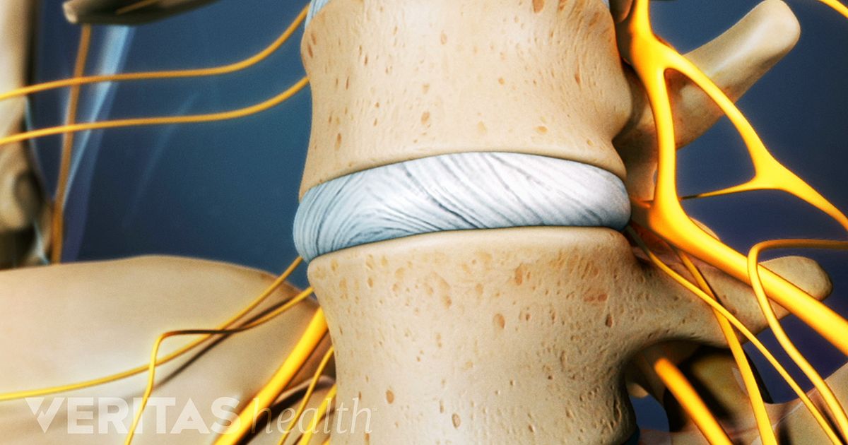 The procedure is used to determine whether the intervertebral disc is the source of back or neck pain