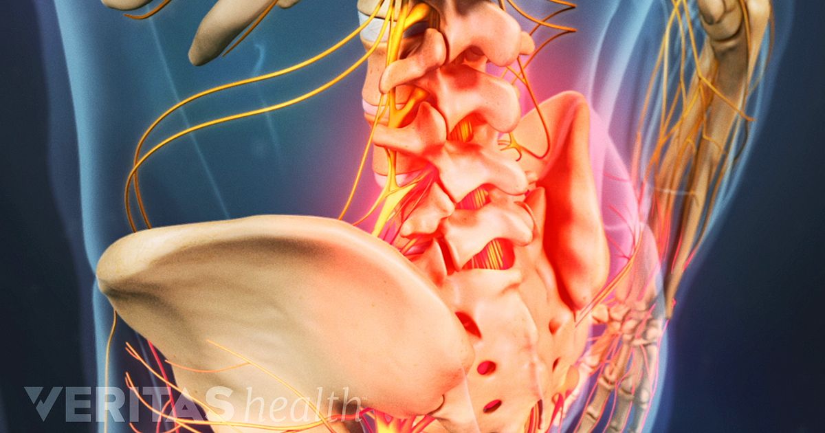 Discogenic Pain Definition | Back Pain and Neck Pain Medical Glossary