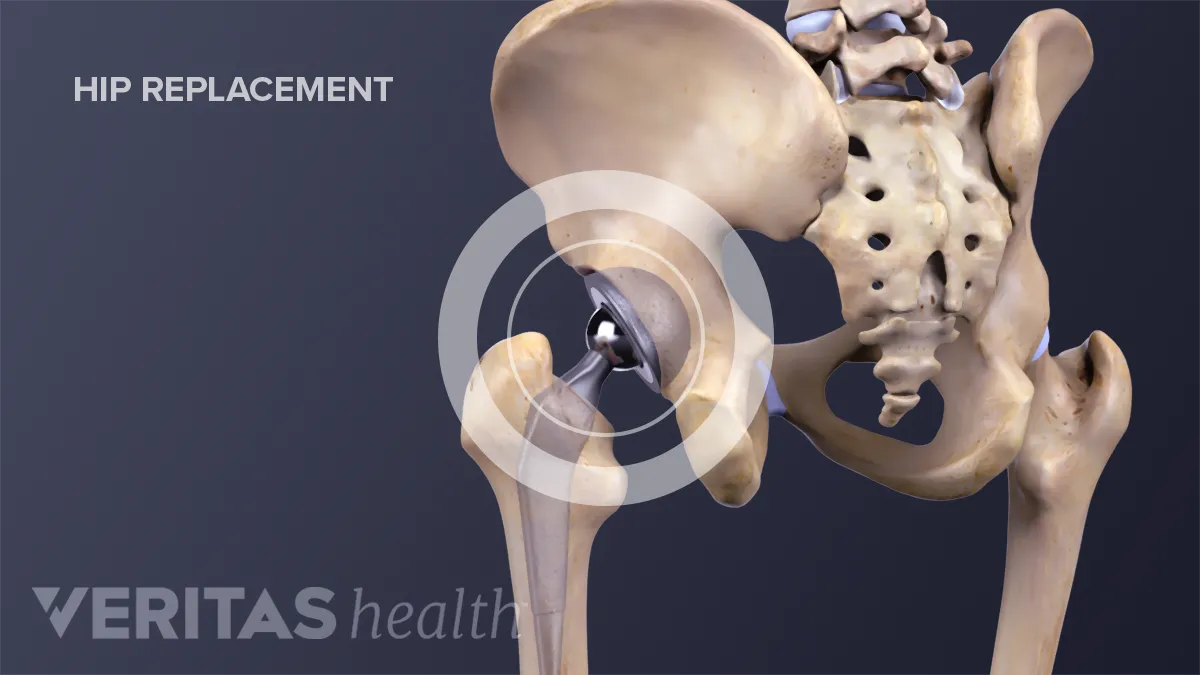 Total Hip Replacement Surgery Risks and Complications | Arthritis ...