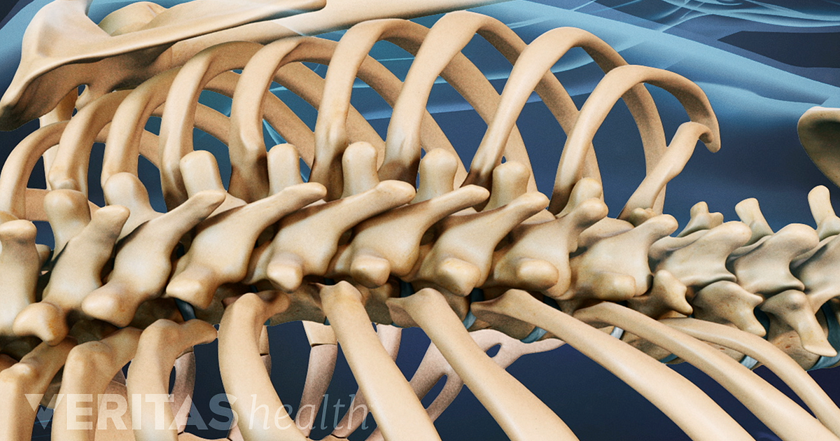 Failed Back Surgery Syndrome (FBSS): What It Is and How to Avoid ...