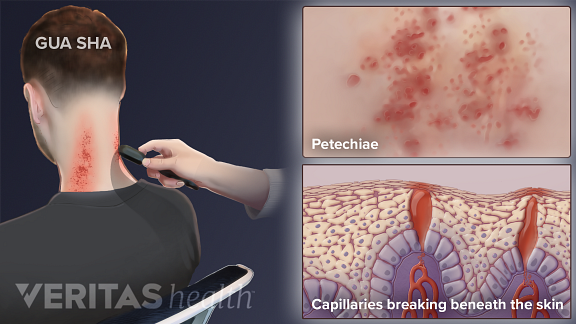 Gua Sha for Chronic Neck Pain Gua Sha for Chronic Neck Pain