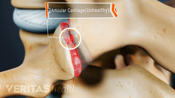 Unhealthy Cartilage