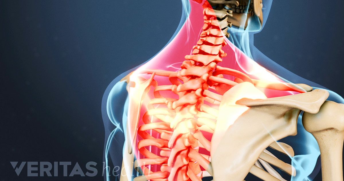 Common Causes Of Back Pain And Neck Pain   Radiating Neck Pain 