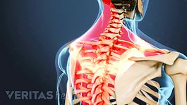 osteoarthritis neck symptoms