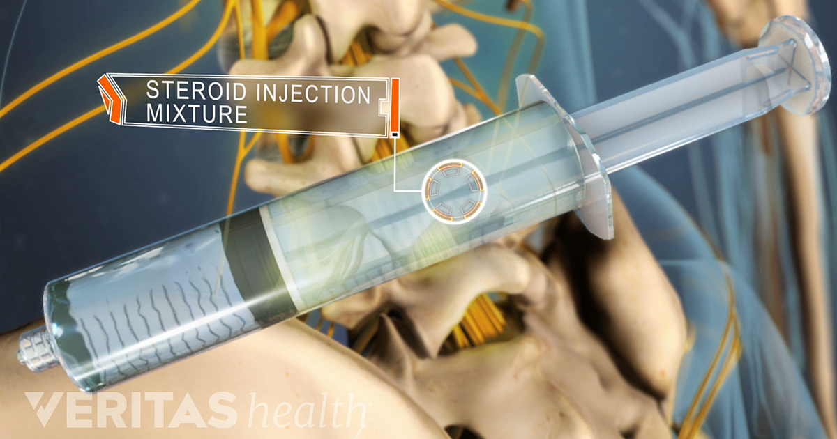 Pain Down Leg During Epidural Steroid Injection