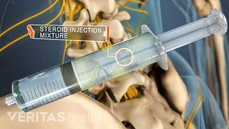 Lumbar Steroid Epidural Injection