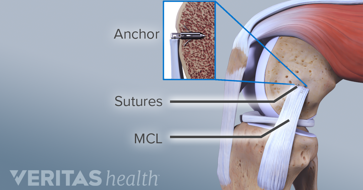 Treatment Options And Recovery For MCL Sprains And Tears