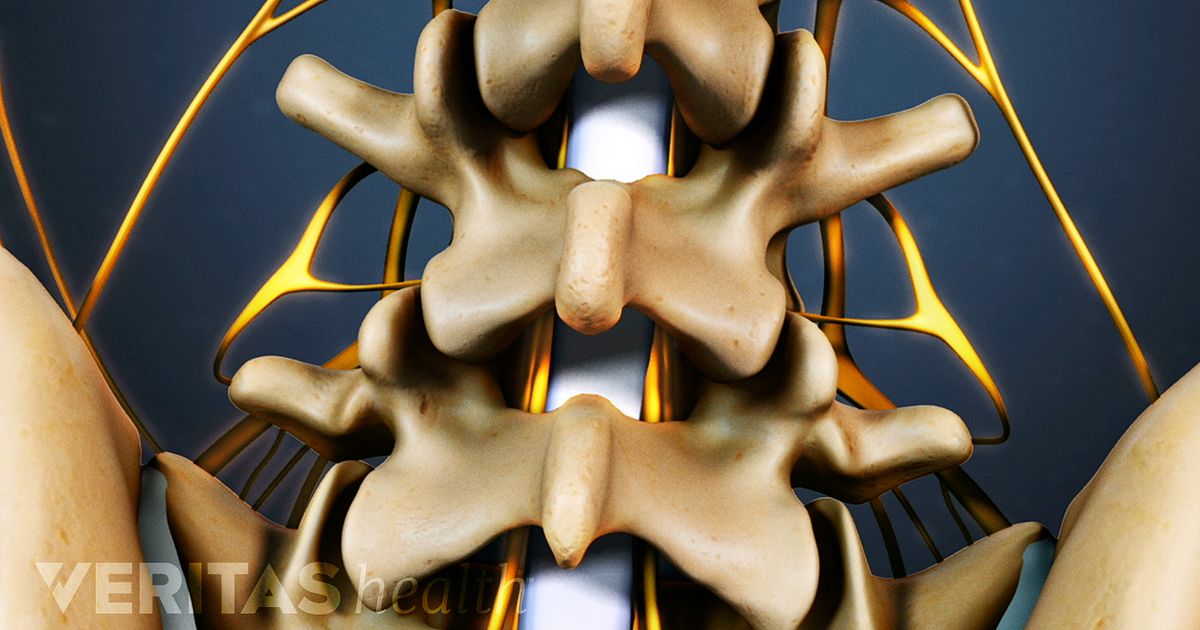 Is Lumbar Fusion Surgery a Reliable Procedure?