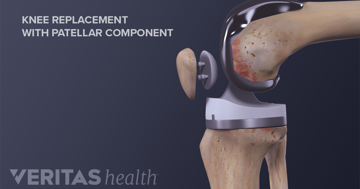 What To Expect After Knee Replacement