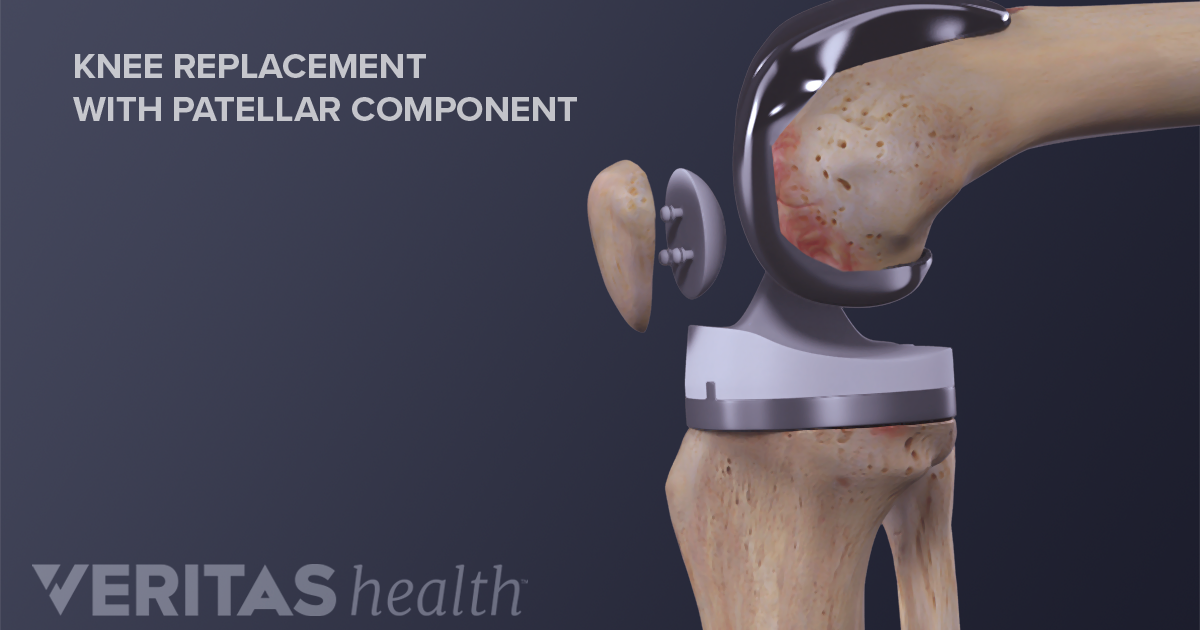 What To Expect After Knee Replacement 9915