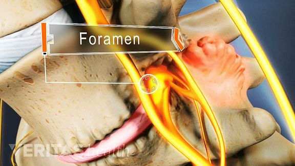 Painful bone spurs can form in the foramina, the small hole through which nerve roots exit the spine.