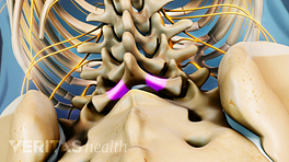 Spinal stenosis in the lumbar spine
