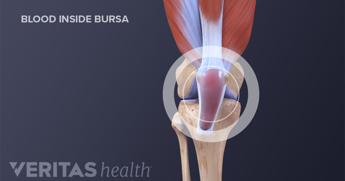 How Infection Can Lead To Severe Knee Pain