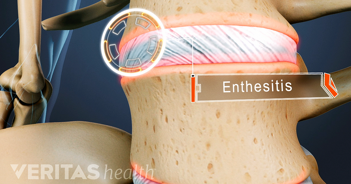 What Is Enthesopathy and Enthesitis 