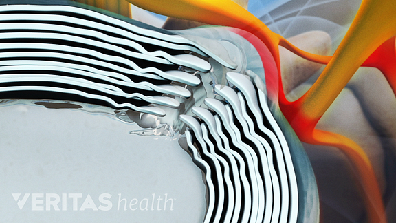 Herniated Disc Video