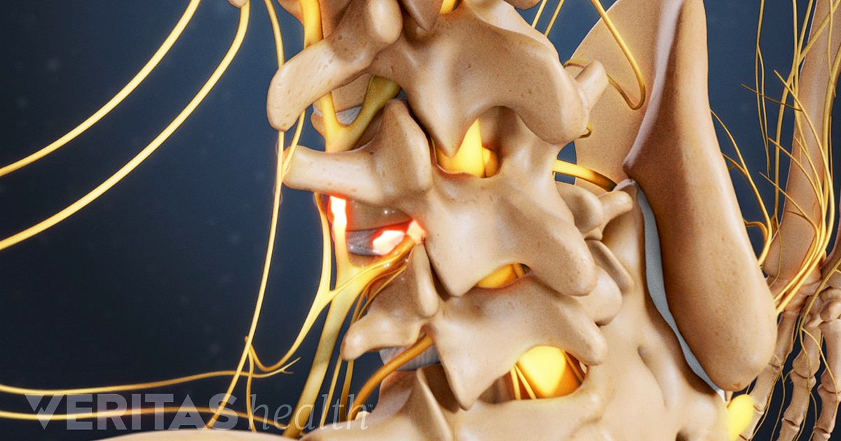 Other Considerations for Failed Back Surgery Syndrome