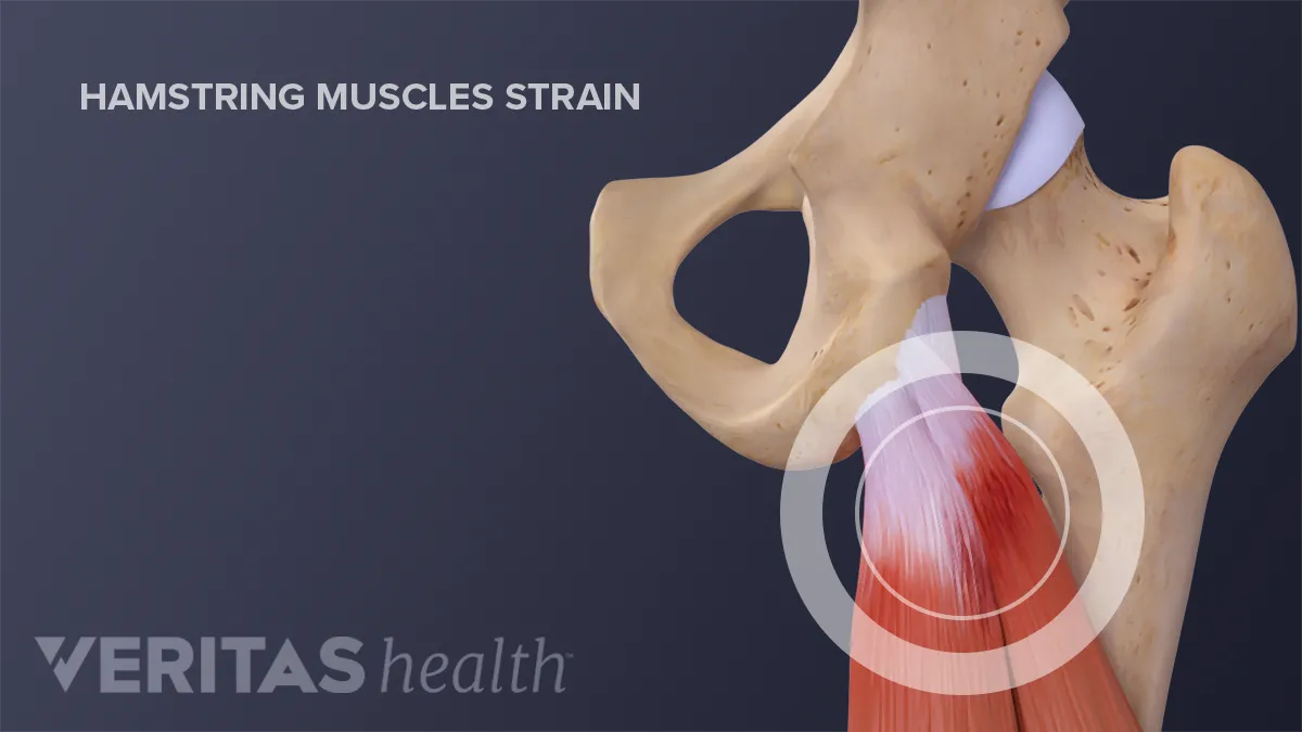 Physiotherapy in Ottawa Area for Hamstring Pain