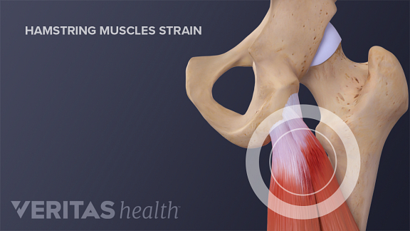 hamstring tear