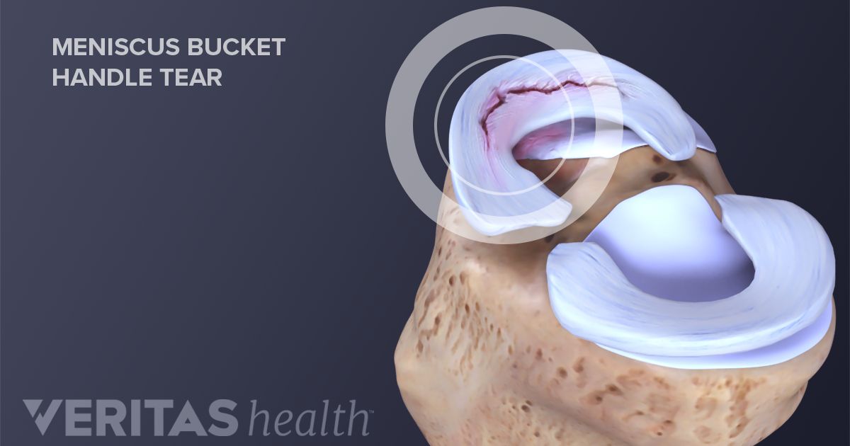 Understanding Meniscus Tears