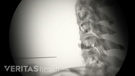 Xray image of injection for the cervical spine.