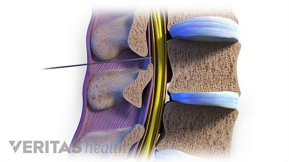 When Do Epidural Steroid Injections Work for Back Pain? When Do Epidural Steroid Injections Work for Back Pain?