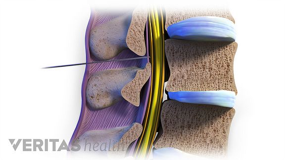 Lumbar Injection