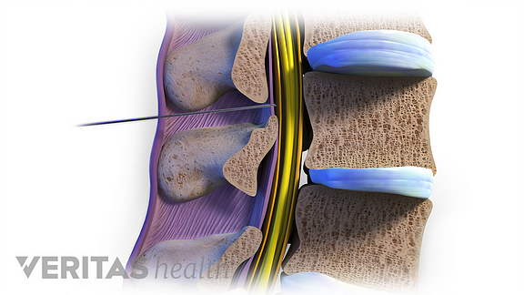 When Do Epidural Steroid Injections Work for Back Pain?