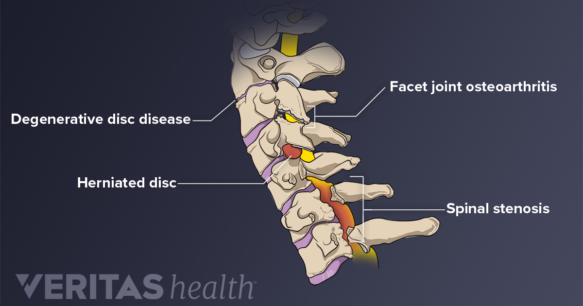 All About The C5 C6 Spinal Motion Segment