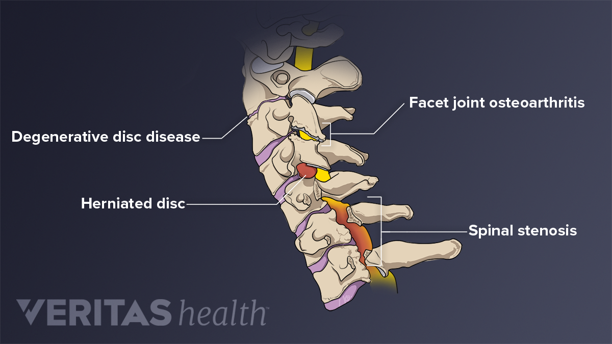 a nyaki régió osteochondrosisa c5 c6)