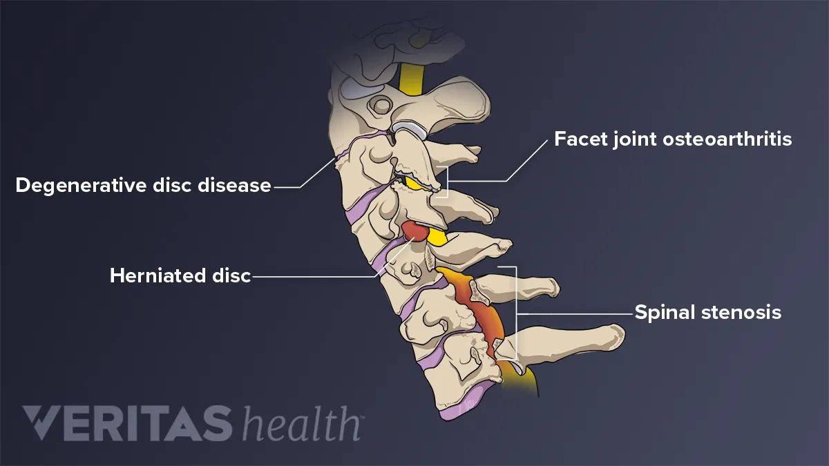 https://embed.widencdn.net/img/veritas/dtsia3bo7h/1200x675px/problems-affecting-cervical-spine.webp