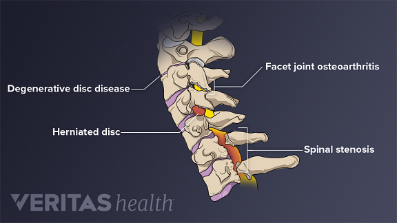 Medical illustration of the cervical spine labeled with common conditions that cause neck stiffness