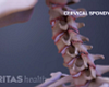 Degenerative Discs showing Cervical Spondylosis with Myelopathy