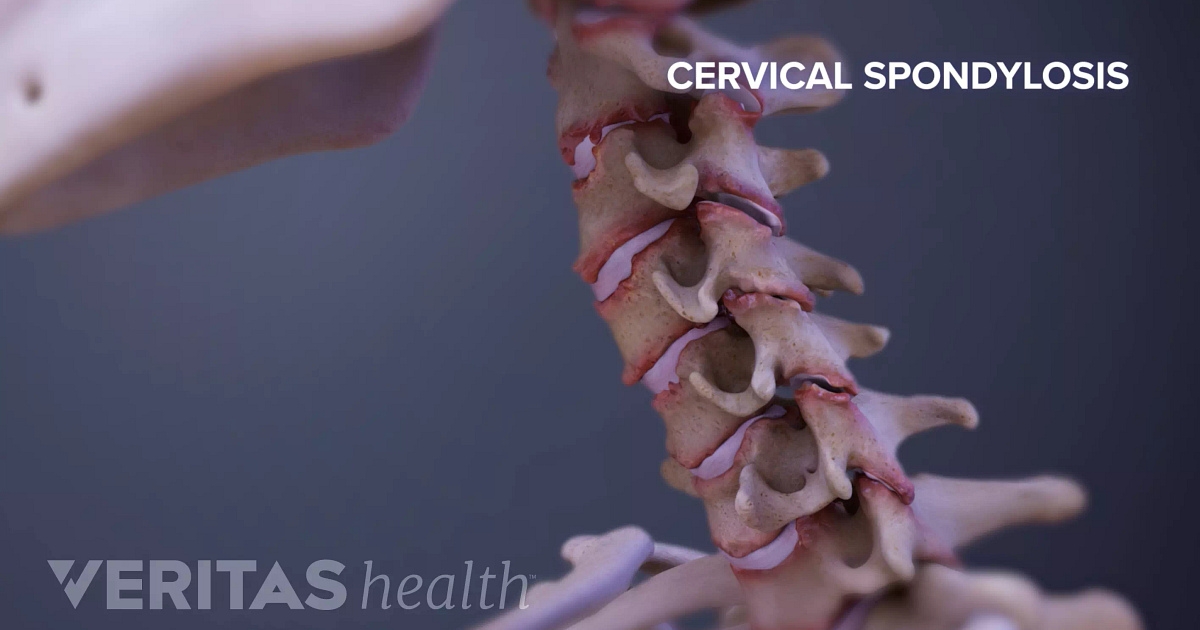 cervical spondylosis with myelopathy icd 10