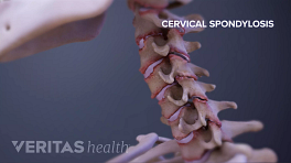 Profile view of spondylosis in between the vertebrae in the cervical spine.