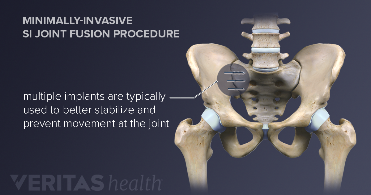 Surgical Treatment For Sacroiliac Joint Pain