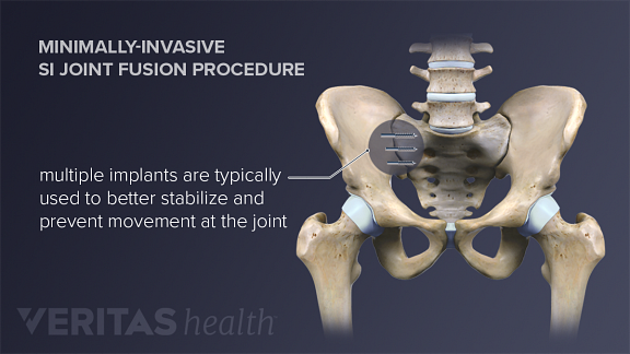 Surgical Treatment For Sacroiliac Joint Pain