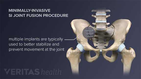 The most common method of sacroiliac joint fusion is a minimally-invasive procedure.