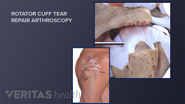 Arthroscopic procedure for a rotator cuff tear