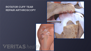 rotator cuff injury surgery