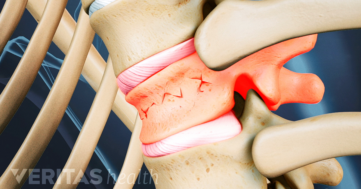 pix L1 Compression Fracture back pain is a spine compression fracture